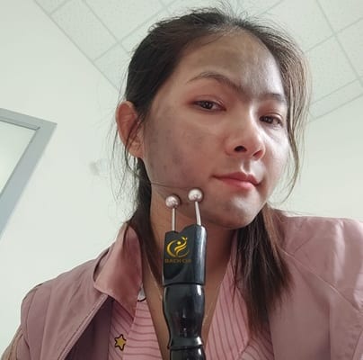 liệu pháp cạo gió