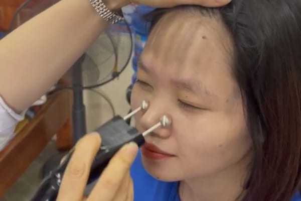 Các trường hợp cấm kỵ cạo gió